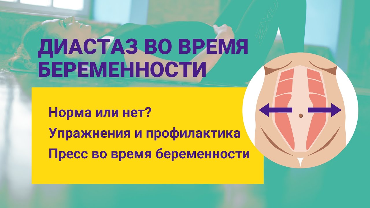 Диастаз у беременных в 3 триместре беременности. Профилактика и упражнения для беременных