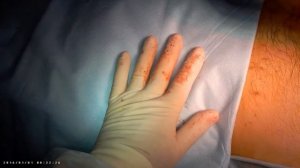 Закрытие стомы (немонтированное)