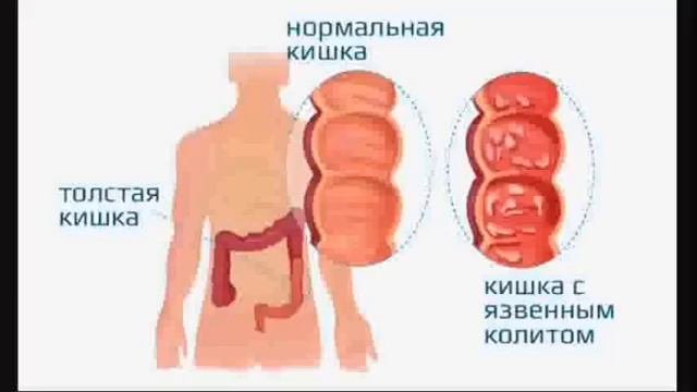 Колит Кишечника отзыв. 🔊