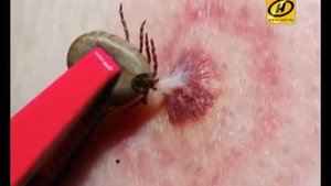 Опасные клещи для человека  Чем опасен иксодовый клещ