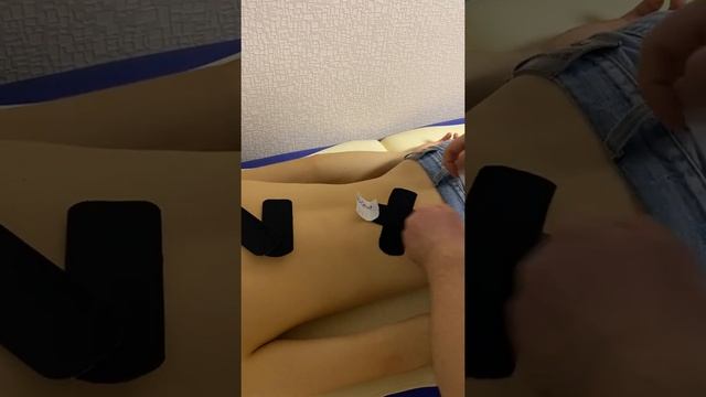 Кинезиотейпирование "Звездочка"
