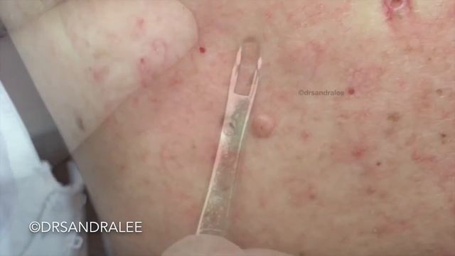 Re-introduction to Big Blackheads on the Back смотреть онлайн