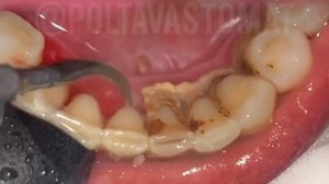 Большой Зубной Камень - Scaling/Teeth Tartar