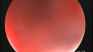 Удаление голосовых связок