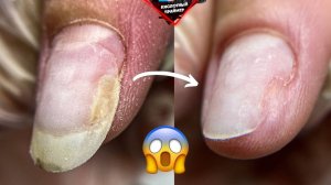 ⚡УДАР ДО ОНИХОЛИЗИСА!? Зачистка онихолизис ногтей на руках?