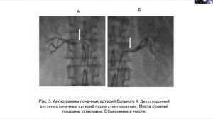 Вторинні артеріальні гіпертензії