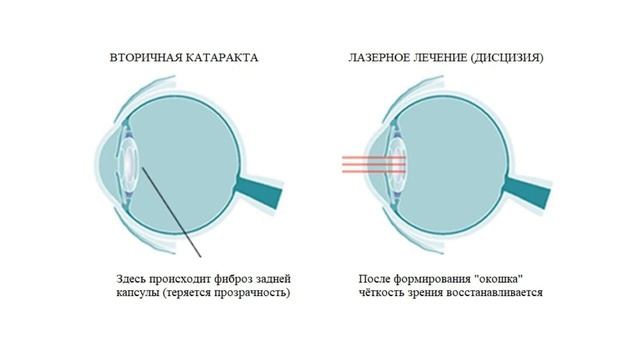 Что такое вторичная катаракта. Дисцизия задней капсулы. Вторичная катаракта лечение.