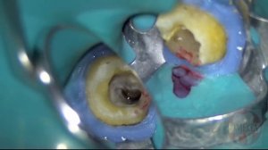 Зуб 4.7 Хр. апикальный  периодонтит