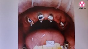 Протезирование. Условно-несъемный протез на корнях своих зубов