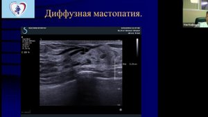 УЗД Молочных желез ч1 Болоцков А С