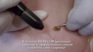 29. Удаление новообразований (невусов)