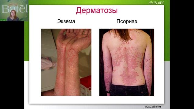 Псорихидол. Заболевания кожи и как с ними справиться смотреть онлайн