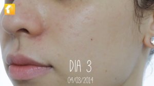 Review   La Roche Posay Effaclar Duo+