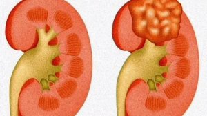 Как не пропустить опухоль почки?