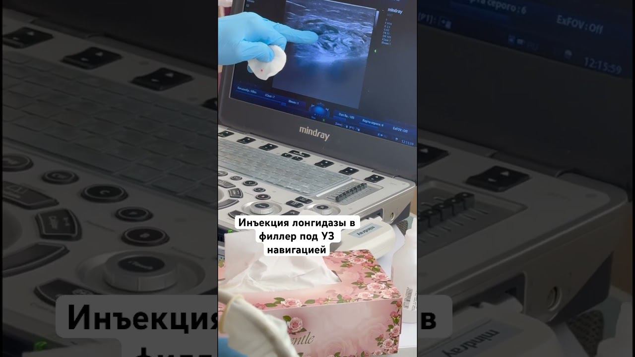 Инъекция лонгидазы в филлер под ультразвуковой ￼навигацией
