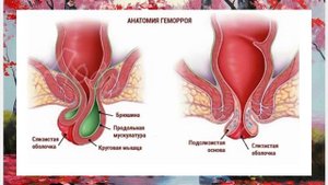 Избавьтесь от ГЕМОРРОЯ ЗА 3 ДНЯ раз и навсегда. Народные рецепты.