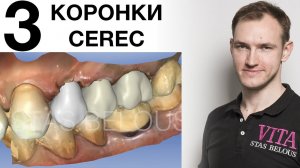 Отремонтировали зубы и сделали красоту коронки Vita Suprinity CEREC #vitazahnfabrik