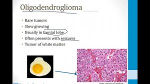 Неврология USMLE - 7. Иные темы - 7.Опухоли головного мозга