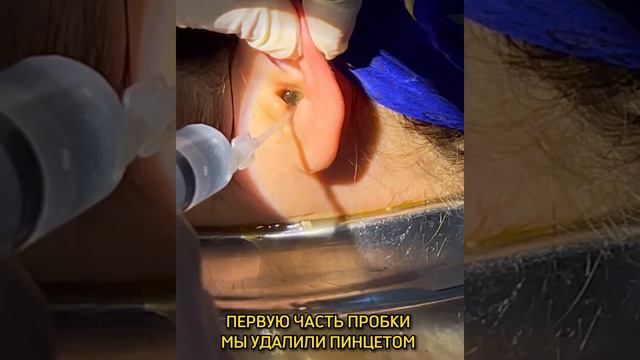 Что за большой кусок достал из уха наш ЛОР Эльдар Разаков ? 🫣😳 смотреть онлайн