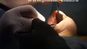 Увеличение груди. Пластический хирург Максим Осин