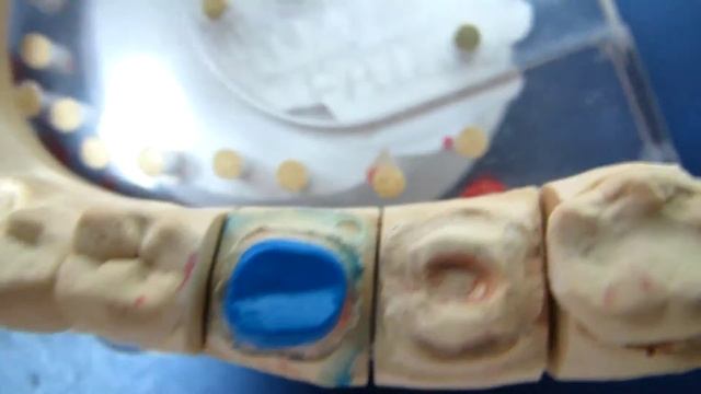 Керамическая вкладка, м/к коронка - Ямамото смотреть онлайн