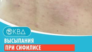? Высыпания при сифилисе. Клинический случай №195