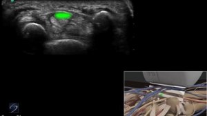 3D-пособие: ультразвуковое исследование лучезапястного сустава при ущемлении срединного нерва