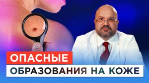 Какие родинки перерастают в рак? Главный дерматолог Минздрава о новообразованиях на коже и меланоме