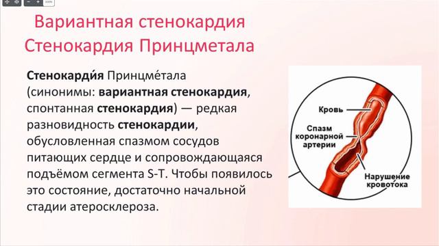 Стенокардия  Биорезонанс для сердечно сосудистой системы  Гнетнева Е А