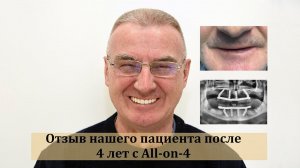 Отзыв пациента спустя 3 года ношения All-on-4