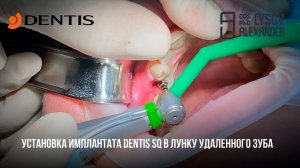 Установка имплантата SQ и формирователя десны DENTIS