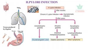 Anti H.pylori drugs - GIT Pharmacology - Part 8