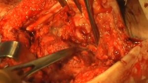 РЕКОНСТРУКЦИЯ ПЯТОЧНОЙ КОСТИ: пластика пористым имплантатом и костным трансплантатом