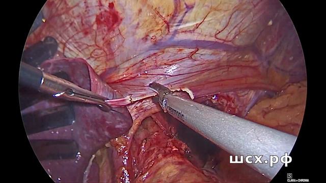 Сложная фундопликация смотреть онлайн