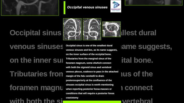 Occipital Venous Sinuses