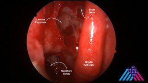 Functional Endoscopic Sinus Surgery (FESS) for sinusitis