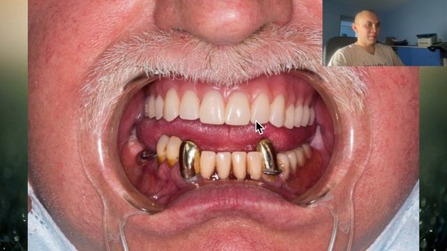 Полный съемный протез. Вариант без неба, и опора на балке. смотреть онлайн