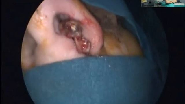 Гигантский полип,пломба в гайморовой пазухе.Эндоскопическое удаление