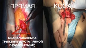 Грыжепластика по Лихтенштейну. Часть 2