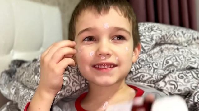 Ветрянка , каламин , ветрянка у детей ! смотреть онлайн