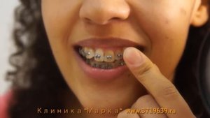 Как правильно чистить зубы и брекеты