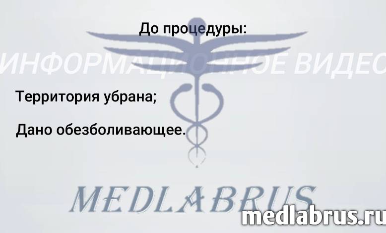 Обрезание новорожденных