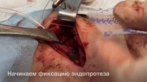 Паховая грыжа. Пластиката по Лихтенштейну