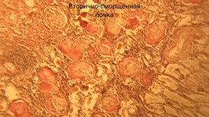 Вторично-сморщенная почка
