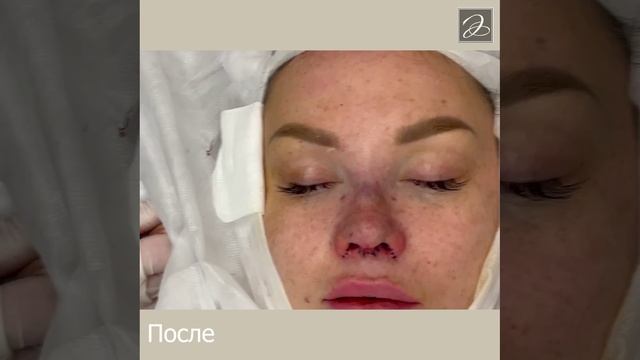 Сразу после ультразвуковой пьезоринопластики