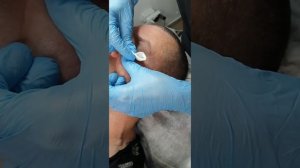 Плазменное омоложение кожи век и удаление папиллом и дряблости