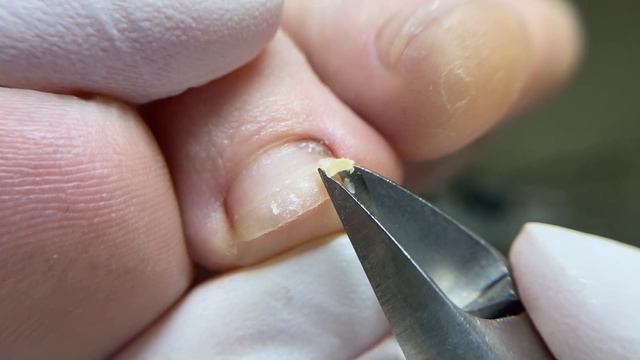 Отдавила ноготь на танцах #Педикюр #подолог#травманогтя#онихолизис #грибокногтей #вросшийноготь смотреть онлайн