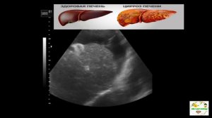 УЗИ печени .Цирроз печени .Асцит.Нити фибрина. Печеночная связка.