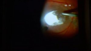 Живая витреоретинальная хирургия часть 3 Расческов А.Ю., к.м.н., г.Казань