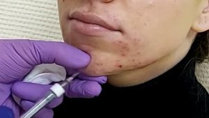 АирисКом студенты учатся: коррекция подбородка, 1мл., 7500р., 4 минуты работы.